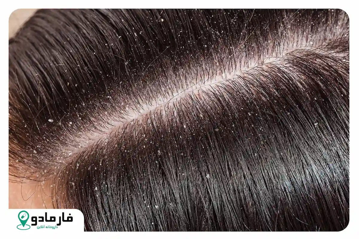 چرا شوره سر می زنیم؟ چگونه درمان کنیم؟